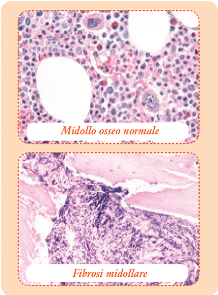 Differenza tra midollo osseo sano e midollo mielofibrotico